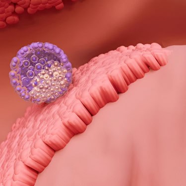 Heart Rhythm Disorder